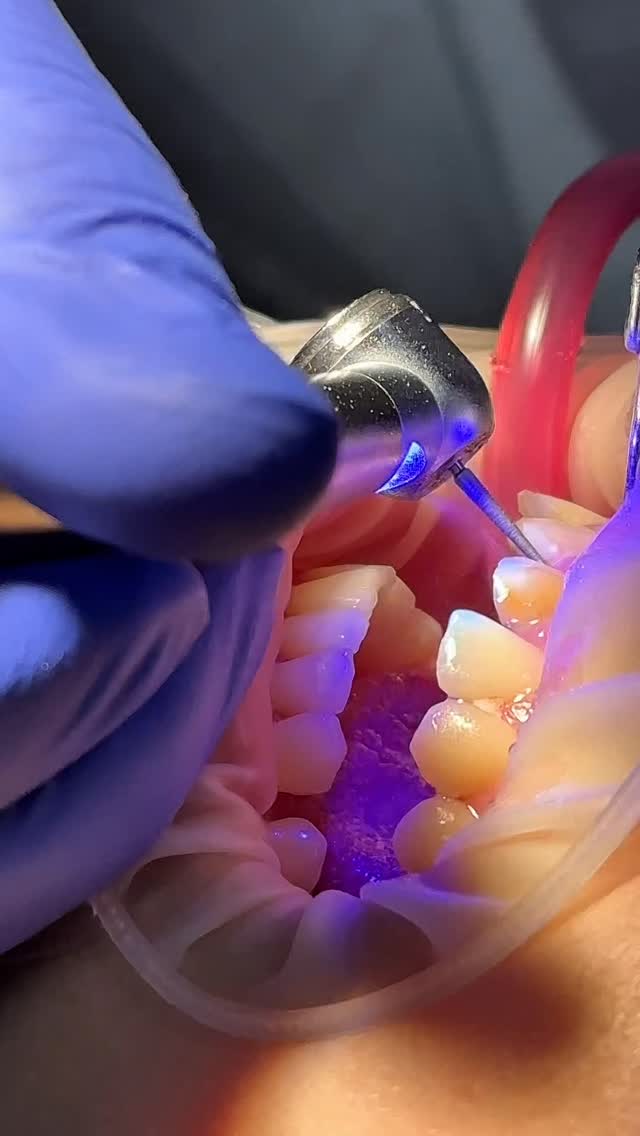 Протезирование и коронки